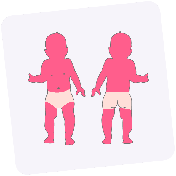 Von Neurodermitis betroffene Stellen bei Babys und Kleinkindern