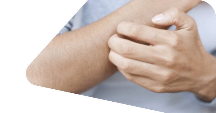 Neurodermitis-Betroffene kratzt sich am Arm