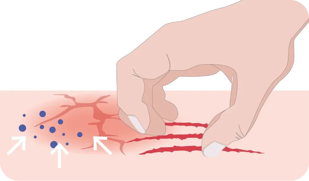 Darstellung des Juck-Kratz-Kreislauf bei Neurodermitis